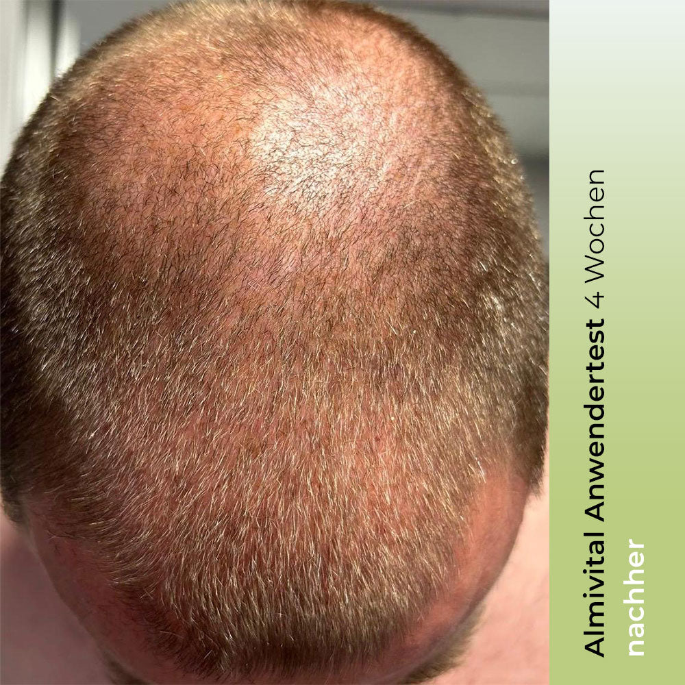 ALMIVITAL Haarkraft Tonic mit AnaGain™ und RootBioTec™ 100ml
