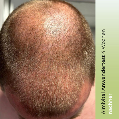 ALMIVITAL Haarkraft Tonic mit AnaGain™ und RootBioTec™ 100ml